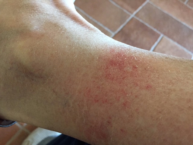 Illustration of Golfer's Vasculitis - Similar rash on my right leg