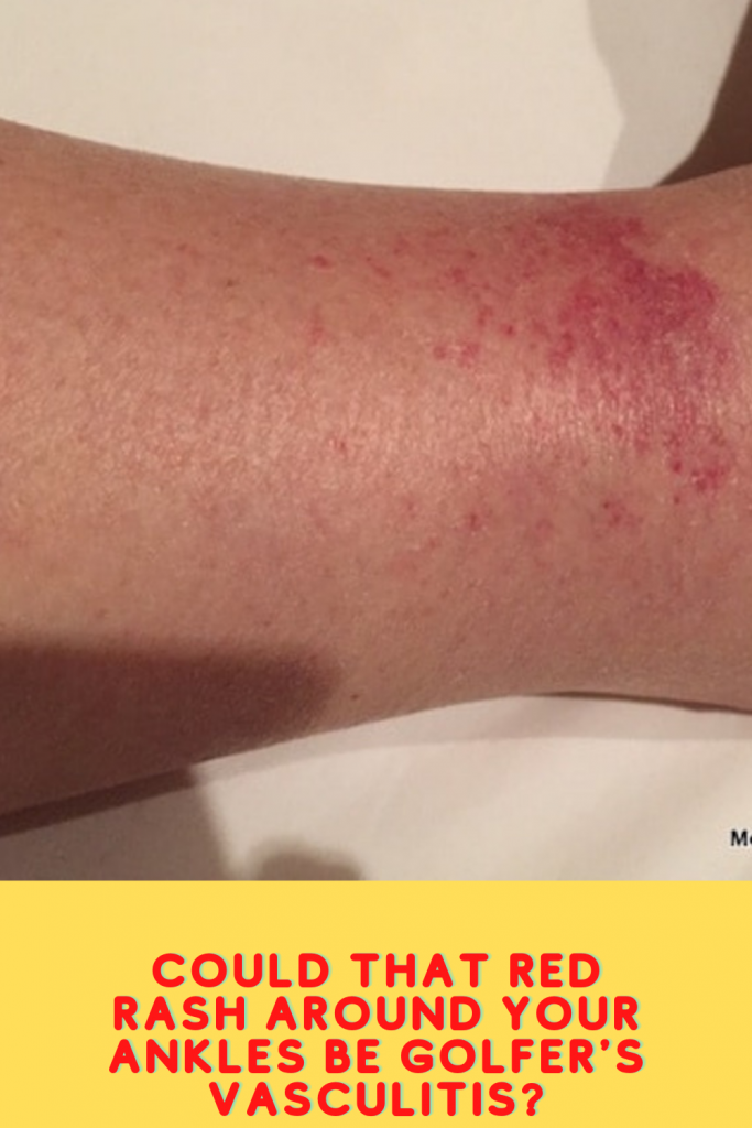 Golfer’s Vasculitis Oops, I Did It Again! MORE TIME TO TRAVEL