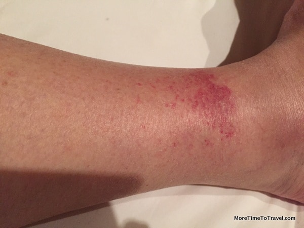 Golfer's Vasculitis in Florence (closeup of right leg)