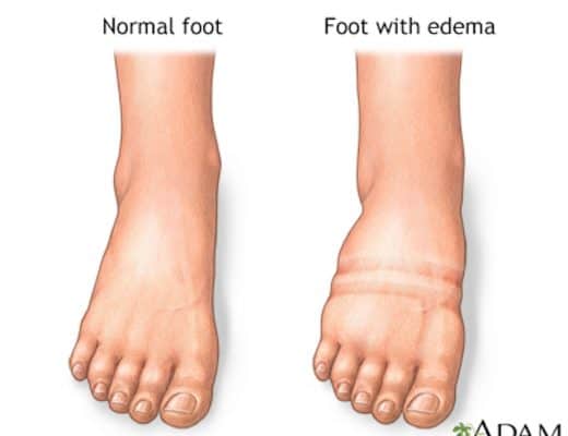 Normal and Swollen Foot