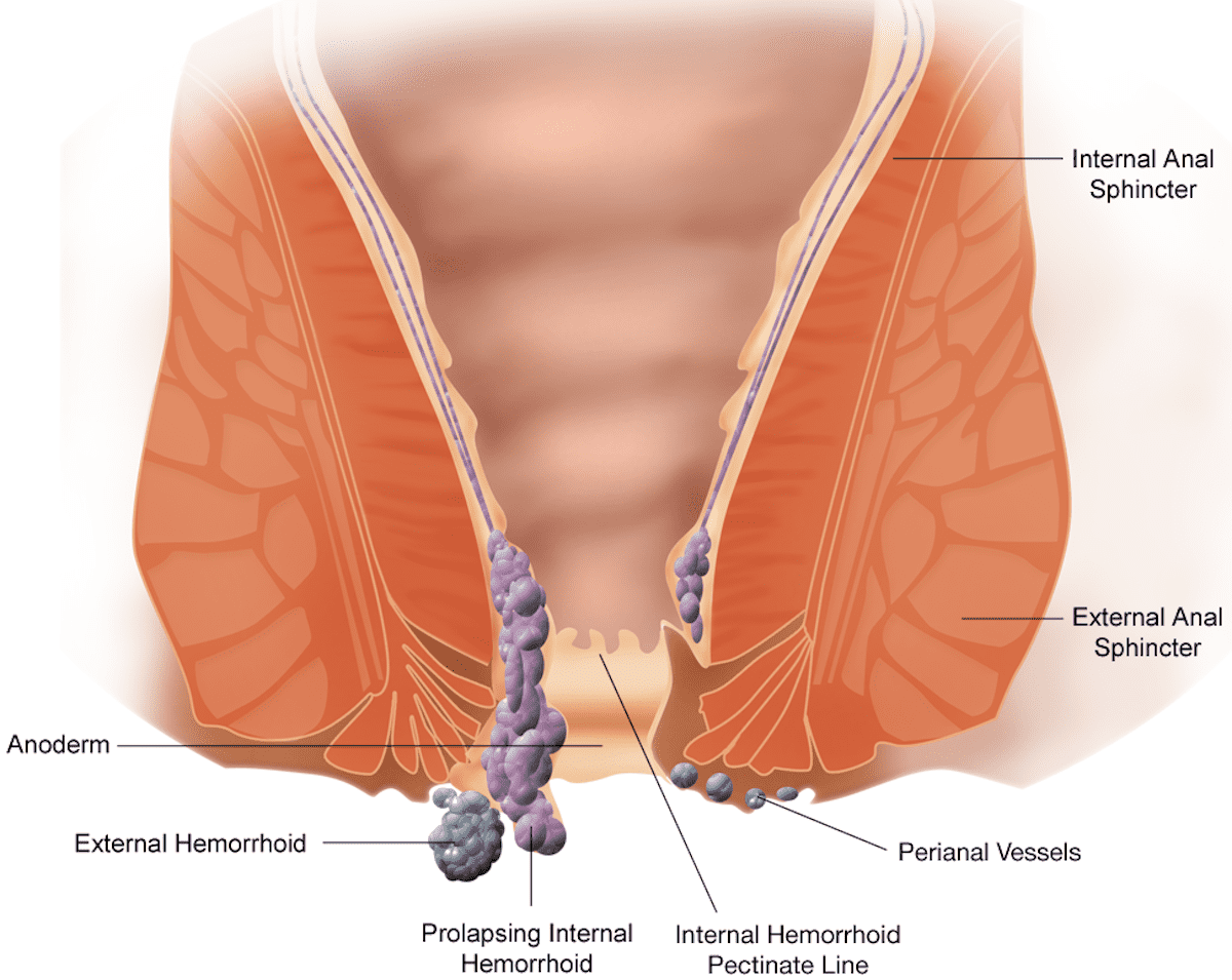 Diagram showing a variety of hemorrhoids