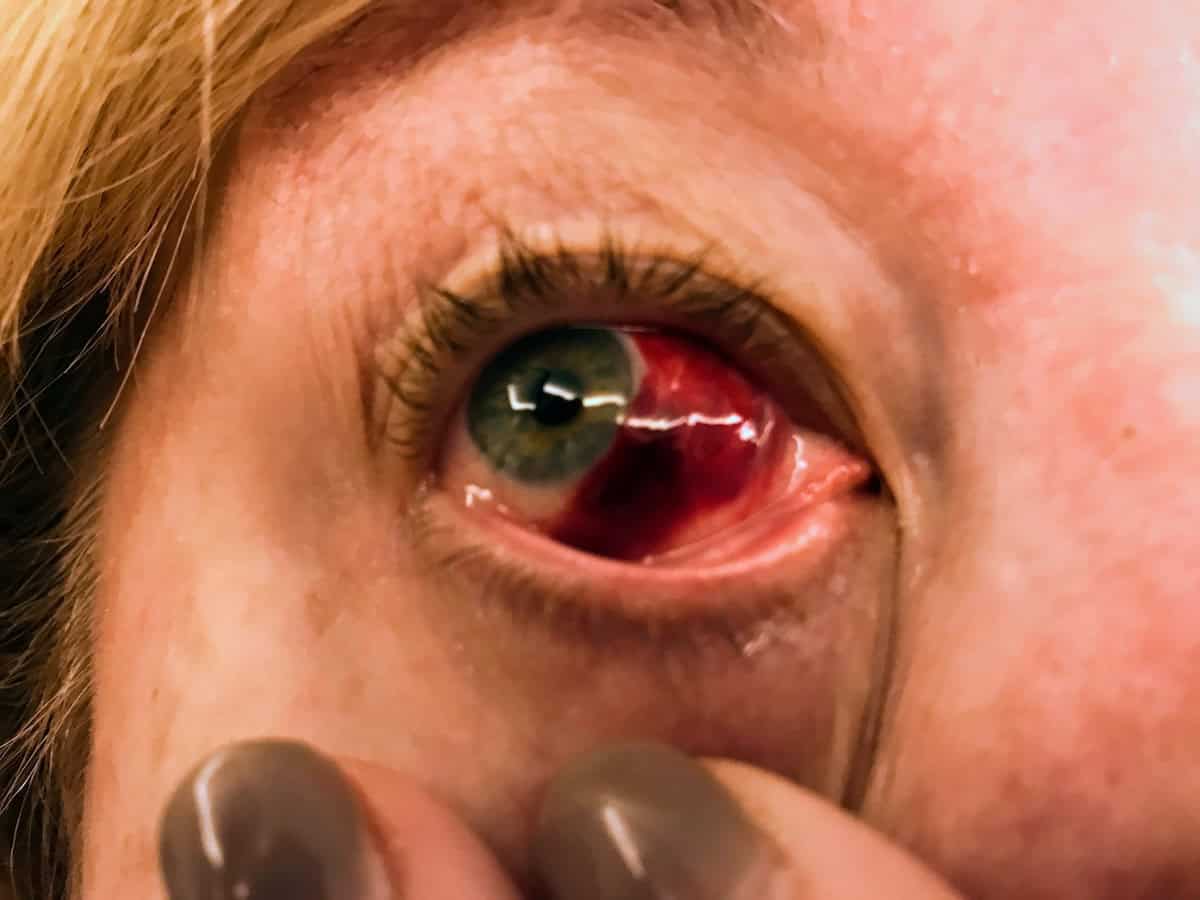Photo of my eye that I sent to my doctor (credit: Jerome Levine)