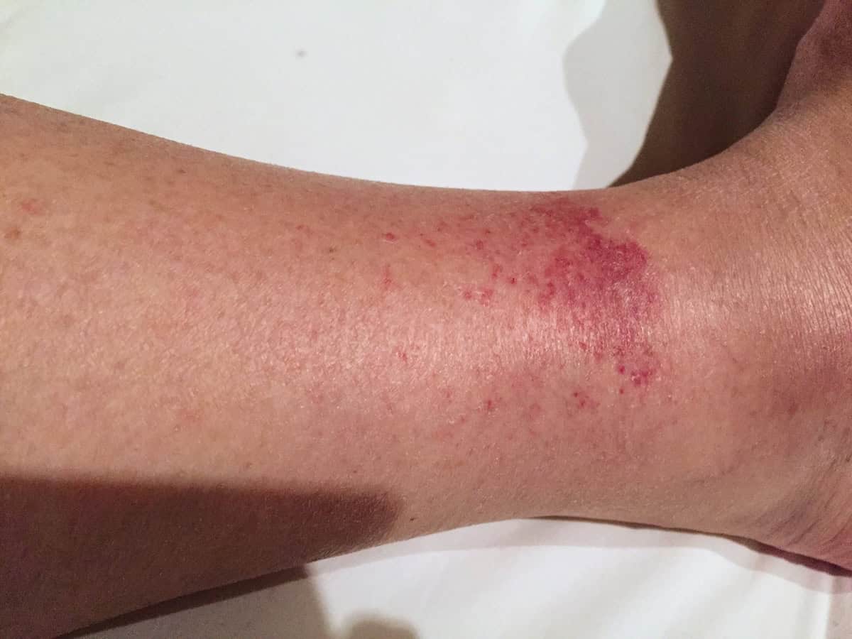 Golfer's Vasculitis Rash on my ankle (credit: Jerome Levine)