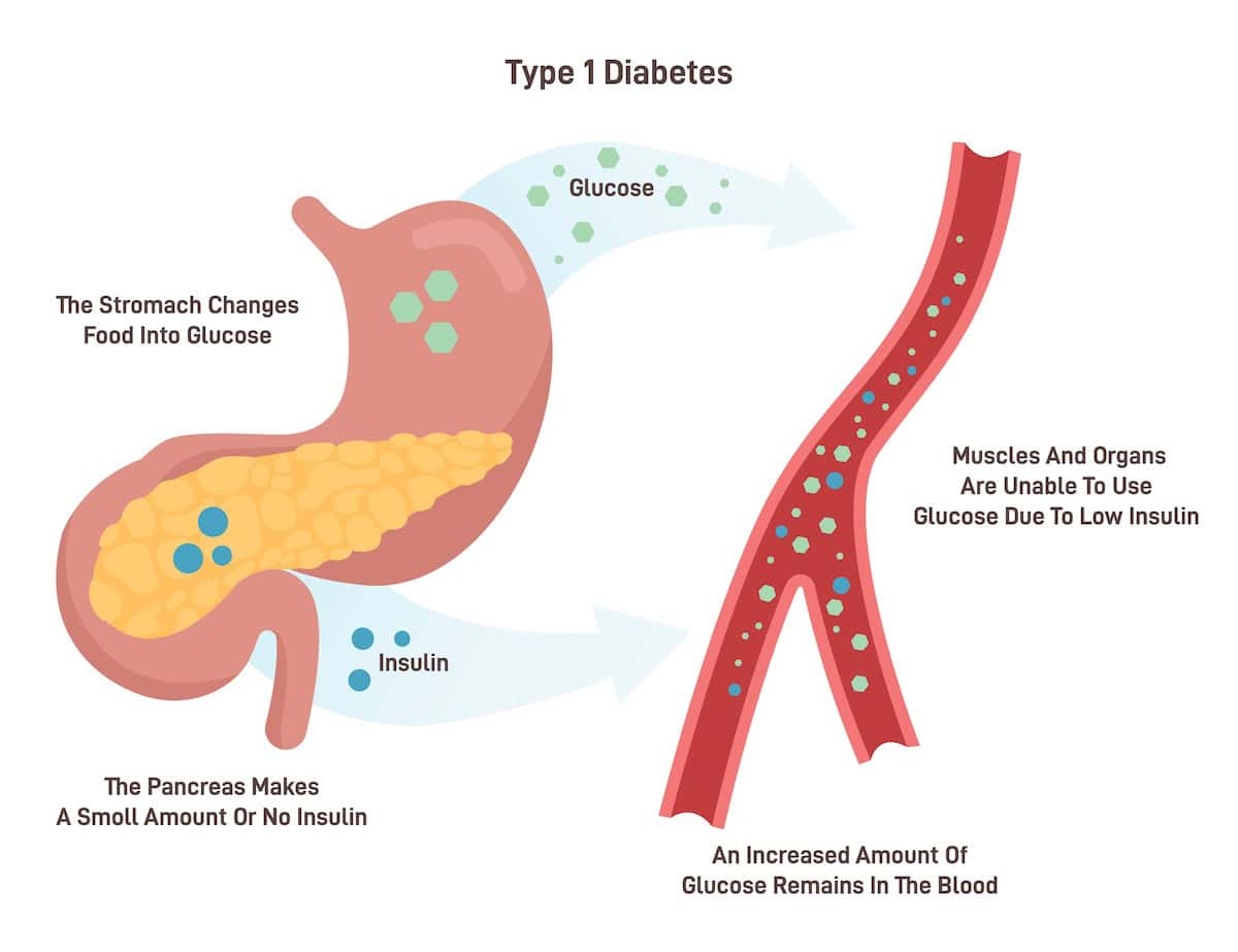 Type 1 diabetes (credit: Adobe stock)
